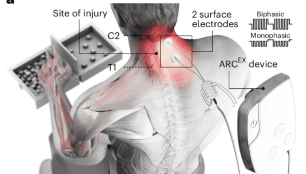 Eindhoven breakthrough: €50 million for walking revolution paraplegic patients