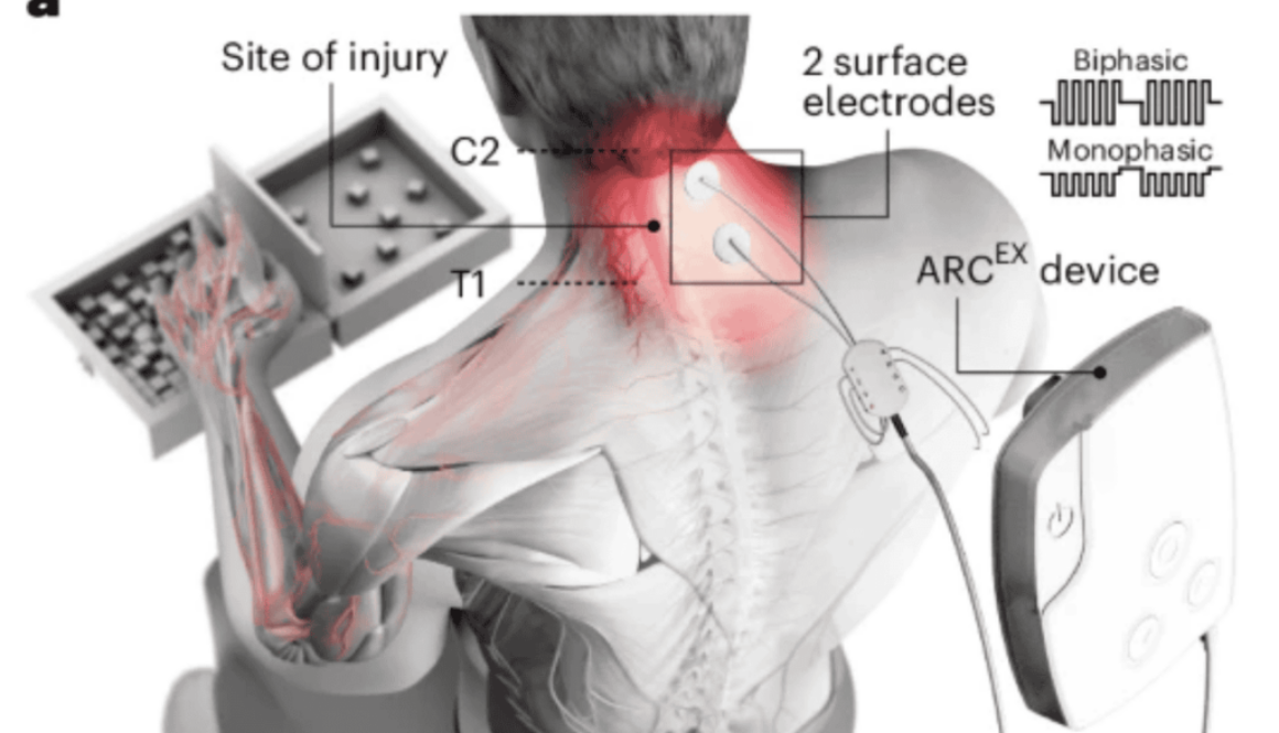 Eindhoven breakthrough: €50 million for walking revolution paraplegic patients