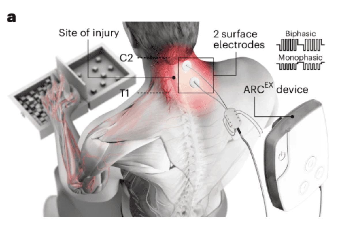 Eindhoven breakthrough: €50 million for walking revolution paraplegic patients